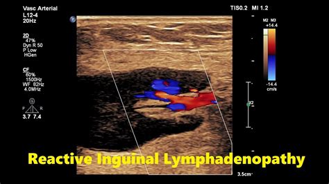 inguinal lymphadenopathy cks